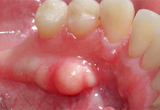Оголение шейки зуба: причины и лечение | Семейная стоматология