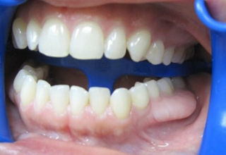 Шишка на десне после удаления зуба