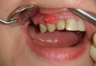 Что делать после удаления зуба | «Доктор Зубов»
