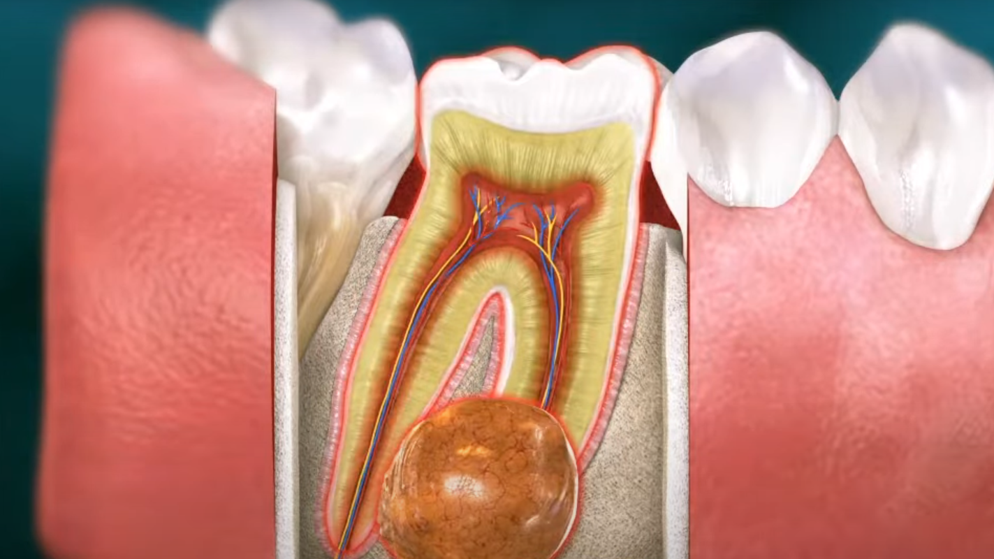 киста на корне зуба на фото