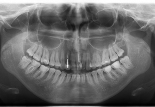 Зубные штифты: фото до и после - Стоматология АристократЪ-Дент