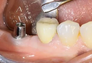 Какая бывает боль после имплантации зубов и сколько она длится